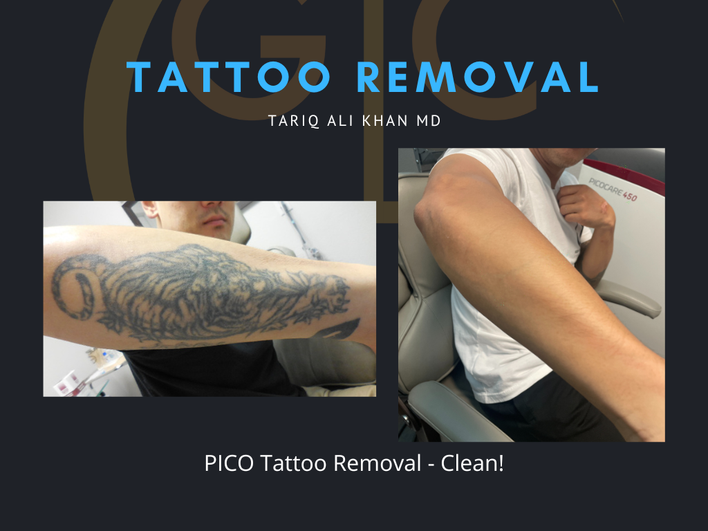 Gentle Care Laser Tustin Before and After picture - Tattoo Removal Mucosal Surface